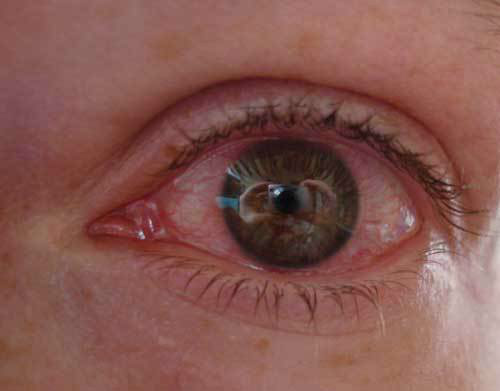 Опух глаз красный и слезится что делать. Лечение – медикаментозное и народное в домашних условиях